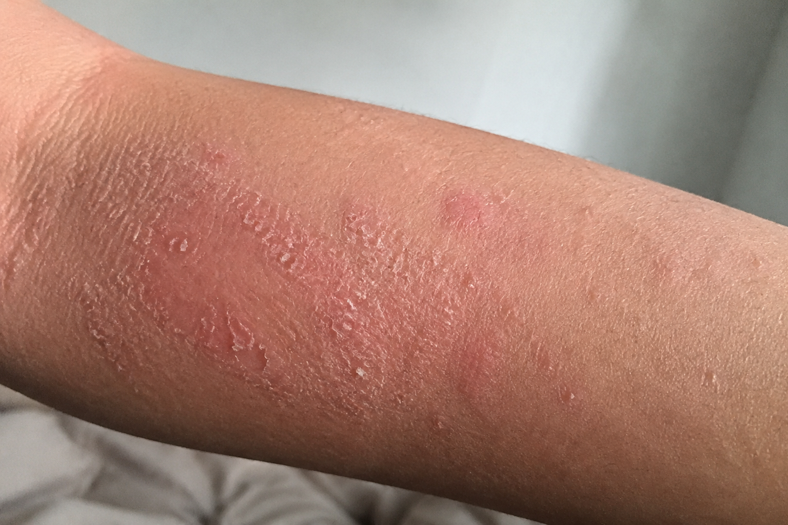 Close-up of dry, irritated skin on a child's arm with mild eczema