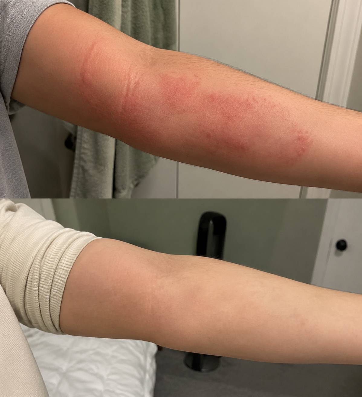 Priya, 29 before and after using TrueTap — Sensitive skin · 6 weeks